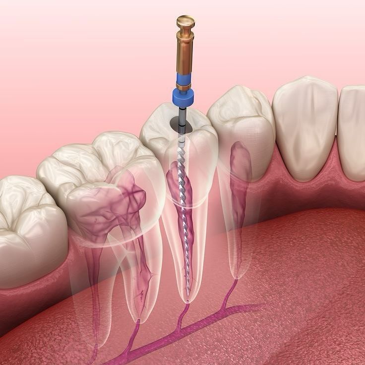 Tratamiento de endodoncia con instrumental especializado